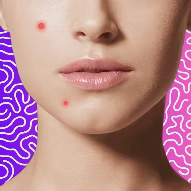 Crazy Pimple Cravos e Espinhas